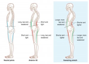 Anterior Pelvic Tilt